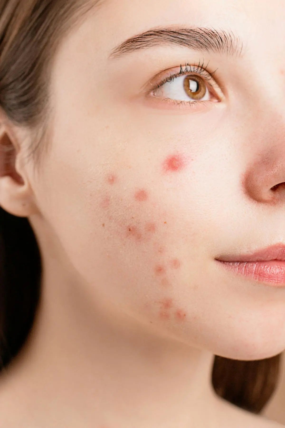 does glutathione make you break out Top 8 Rich Foods For Glowing & Healthy Skin Acne: Types, Causes, Treatment, and